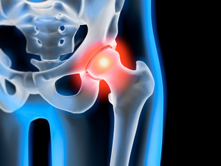 You Can Get Relief for These 5 Painful Hip Conditions: Dr. Stem Cell:  Regenerative Orthopedics